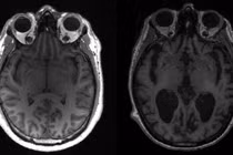 Xuất hiện bệnh lạ ảnh hưởng não ở Canada 