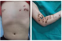 Loét da sâu không khỏi sau khi tiếp xúc với sứa biển