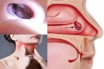 Nghi ngờ ung thư mũi xoang người bệnh cần làm các xét nghiệm nào? 