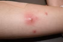 Chữa mụn nhọt cho trẻ tại nhà