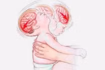 Não trẻ bị ảnh hưởng nghiêm trọng thế nào khi bị rung lắc, quăng quật?