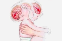 Não trẻ bị ảnh hưởng nghiêm trọng thế nào khi bị rung lắc, quăng quật?