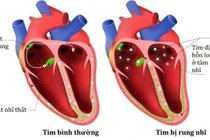 Nguy cơ của rung nhĩ vô căn