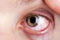 Đái tháo đường tuýp nào biến chứng mau hơn?