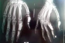 Xương chảy nến