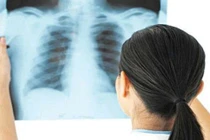 Ho, có đờm kéo dài: Không nên chủ quan