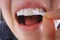 Tẩy trắng răng siêu tốc rất độc hại