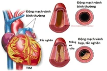 Các phương pháp điều trị bệnh động mạch vành