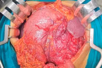 Cắt u GIST dạ dày khổng lồ biến chứng ung thư