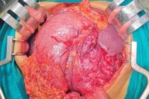 Cắt u GIST dạ dày khổng lồ biến chứng ung thư