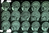 Tưởng con bị hậu COVID-19 nào ngờ giun đũa chó mèo trong não