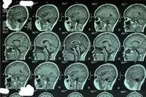 Tưởng con bị hậu COVID-19 nào ngờ giun đũa chó mèo trong não