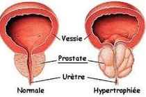 Phì đại tiền liệt tuyến có phải mổ không?
