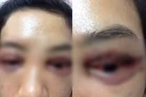 Hỏng mắt vì nhấn mí đôi bằng khâu chìm