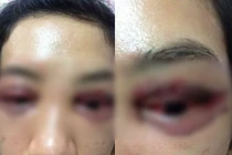 Hỏng mắt vì nhấn mí đôi bằng khâu chìm