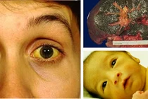 Thuốc chữa vàng mắt, vàng da do ăn uống