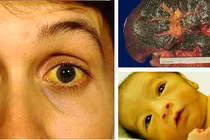 Thuốc chữa vàng mắt, vàng da do ăn uống