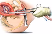 Mỗi năm Hà Nội giảm 2/3 số vị thành niên, thanh niên có thai ngoài ý muốn