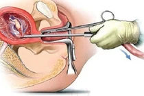 Mỗi năm Hà Nội giảm 2/3 số vị thành niên, thanh niên có thai ngoài ý muốn
