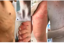 Tổn thương da ở bệnh nhân Covid-19