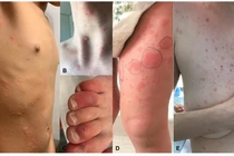 Tổn thương da ở bệnh nhân Covid-19