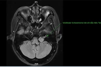 Ù tai, chóng mặt phát hiện u dây thần kinh tiền đình - ốc tai