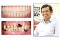 Giải pháp tối ưu trong điều trị mất răng toàn hàm từ nghiên cứu khoa học của TS Trần Hùng Lâm