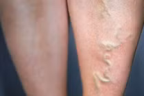 Chọn tất cho người giãn tĩnh mạch chân