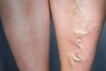 Chọn tất cho người giãn tĩnh mạch chân