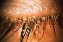 Tá hỏa khi phát hiện hơn 100 con giận làm tổ ở mắt