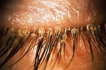 Tá hỏa khi phát hiện hơn 100 con giận làm tổ ở mắt