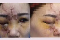 Tiêm filler “đội lốt collagen thay đổi vận nhiều người nhiều người hỏng mặt