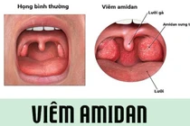 Viêm amidan mạn tính khi nào phẫu thuật?