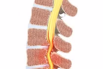 Tập lưng làm giảm đau thần kinh tọa do hẹp ống sống