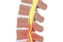 Tập lưng làm giảm đau thần kinh tọa do hẹp ống sống