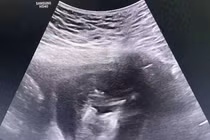 Song thai dính nhau chung 1 quả tim