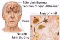 Công nghệ “đọc não” Phát hiện sớm bệnh Alzheimer