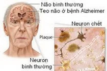 Công nghệ “đọc não” Phát hiện sớm bệnh Alzheimer