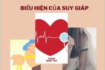 Người bị viêm tuyến giáp Hashimoto thường có biểu hiện của suy giáp.