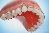 Mắc nhiều bệnh vì chỉnh nha vội