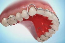 Mắc nhiều bệnh vì chỉnh nha vội