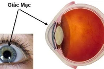 Viêm giác mạc sợi càng chữa càng khó nhìn