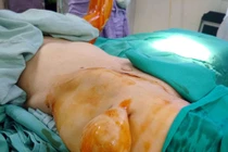 Cắt khối u mỡ to bất thường tồn tại 43 năm