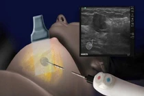 Nitơ lỏng đông lạnh diệt khối u