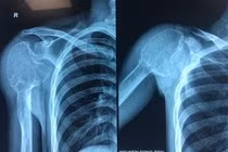 Nang xương phình mạch khổng lồ ăn hết cả khớp vai và xương cánh tay. 
