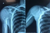 Nang xương phình mạch khổng lồ ăn hết cả khớp vai và xương cánh tay. 