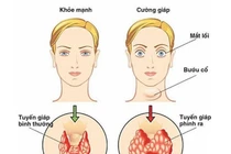 Điều trị bướu cổ đơn thuần khác bướu cổ Basedow