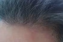 Khi bị nấm da đầu không nên ăn đồ dễ kích ứng