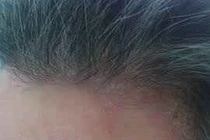 Khi bị nấm da đầu không nên ăn đồ dễ kích ứng