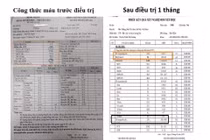 Phác đồ Lenalidomide – Dexamethasol liều thấp cứu bệnh nhân suy tủy do đa u tủy xương